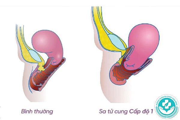 hình ảnh sa tử cung độ 1