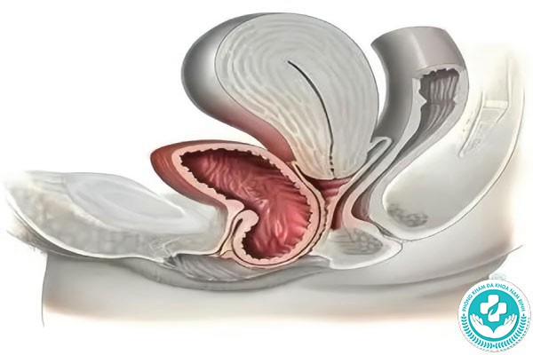hình ảnh sa tử cung độ 1