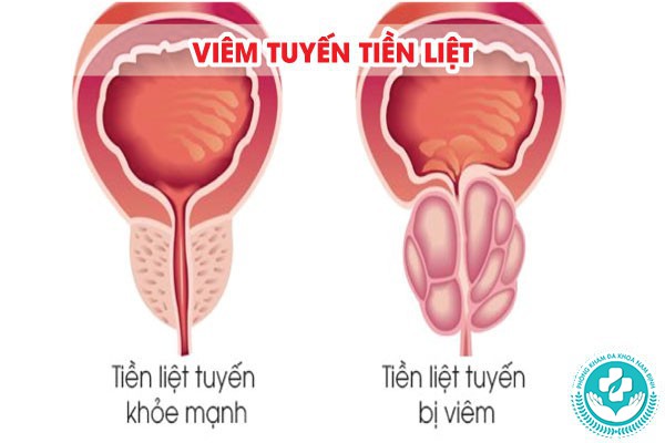 hình ảnh viêm nhiễm nam khoa hình ảnh viêm nhiễm nam khoa