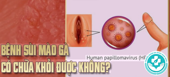 HPV có chữa khỏi hoàn toàn không