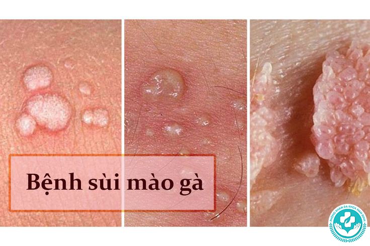 HPV và sùi mào gà khác nhau không HPV và sùi mào gà khác nhau không