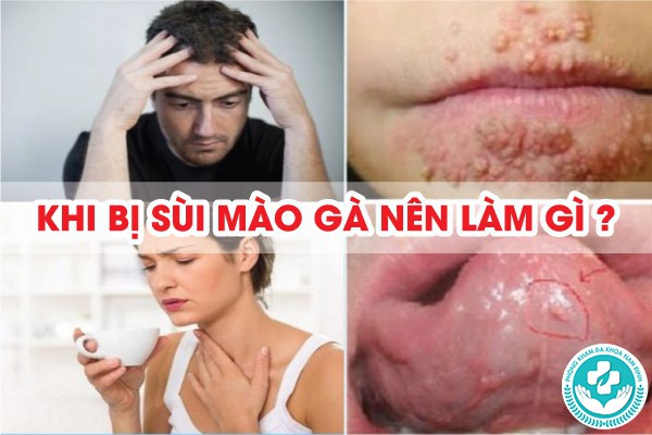 khi bị sùi mào gà nên làm gì