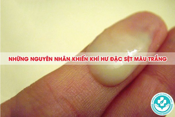 khí hư đặc sệt màu trắng