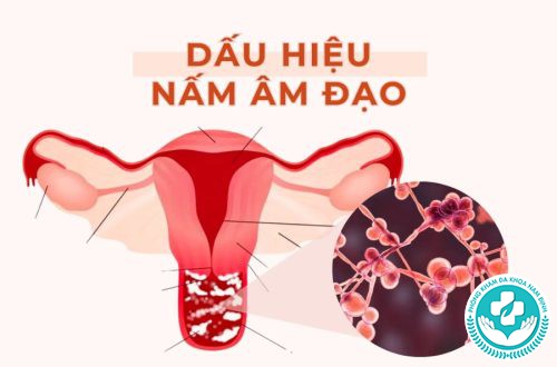 Làm sao để biết mình bị nấm vùng kín Làm sao để biết mình bị nấm vùng kín