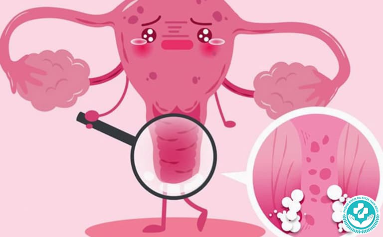 Làm sao để biết mình bị nấm vùng kín Làm sao để biết mình bị nấm vùng kín