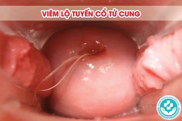 làm sao để biết viêm lộ tuyến cổ tử cung