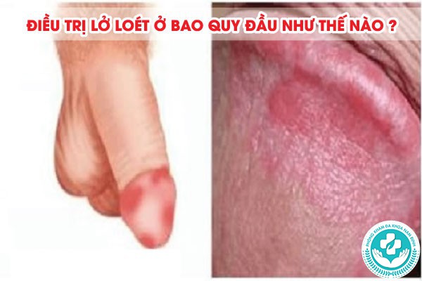 lở loét ở bao quy đầu
