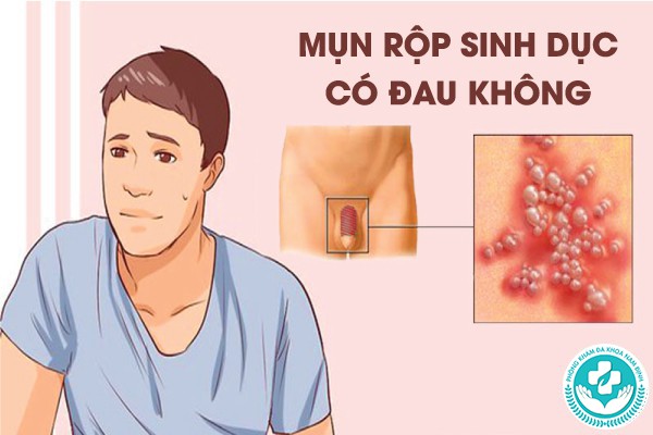 mụn rộp sinh dục có đau không