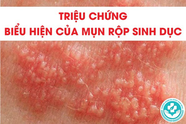 mụn rộp sinh dục có đau không