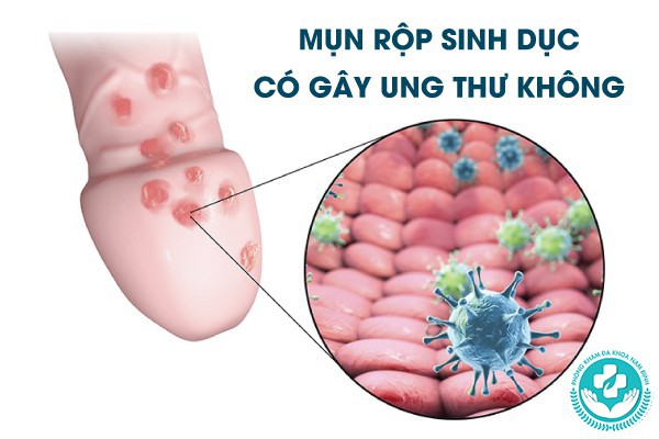 mụn rộp sinh dục có gây ung thư không