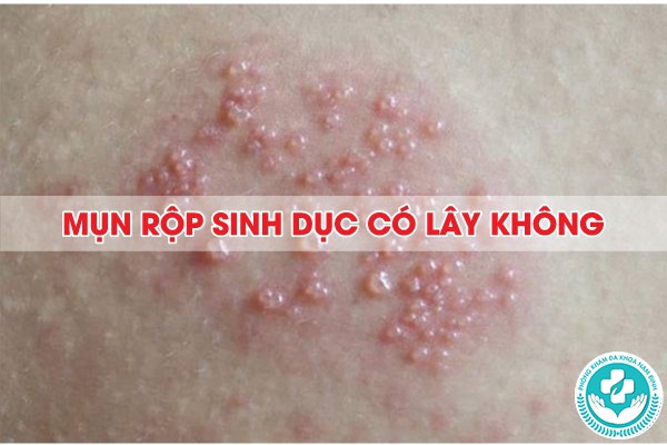 mụn rộp sinh dục có lây không