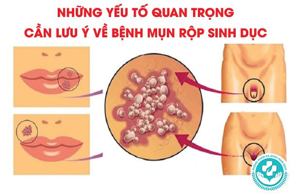 mụn rộp sinh dục có lây không