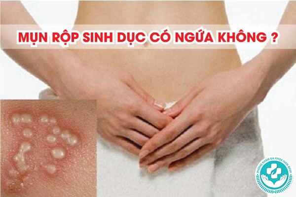 mụn rộp sinh dục có ngứa không