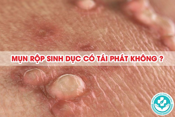 mụn rộp sinh dục có tái phát không