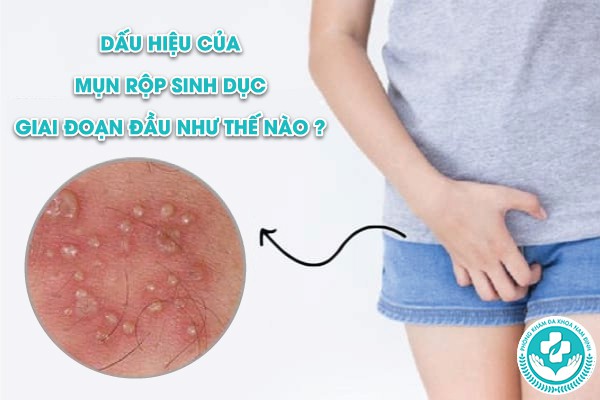 mụn rộp sinh dục giai đoạn đầu