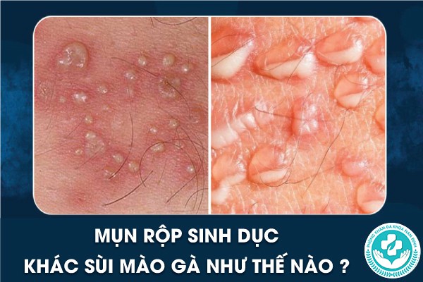 mụn rộp sinh dục khác sùi mào gà