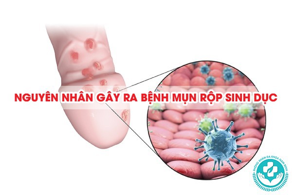 mụn rộp sinh dục là bệnh gì