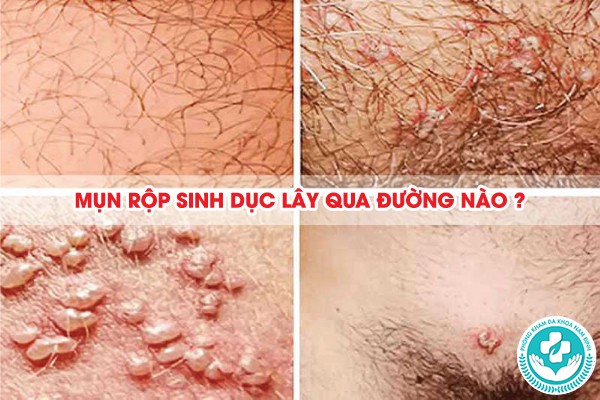 mụn rộp sinh dục lây qua đường nào