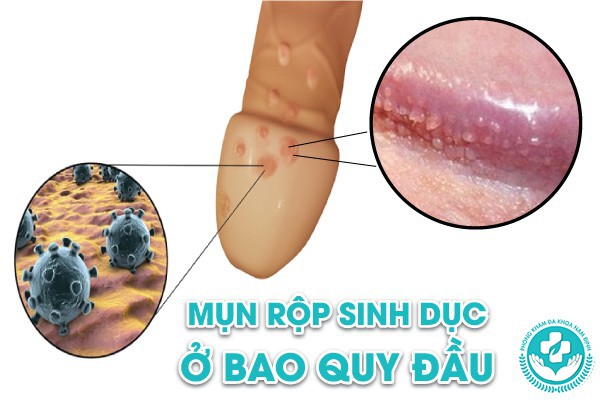 mụn rộp sinh dục ở bao quy đầu