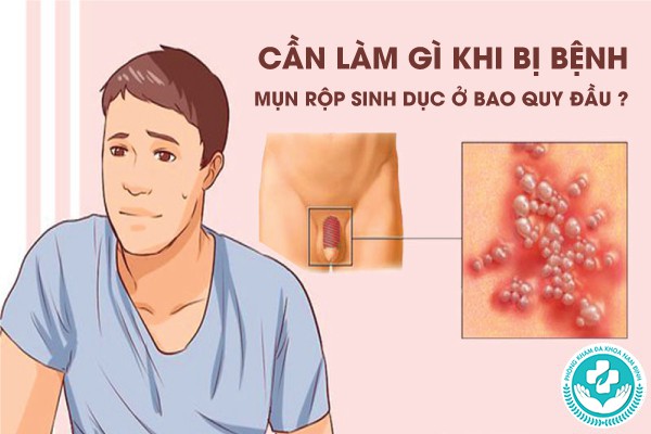 mụn rộp sinh dục ở bao quy đầu