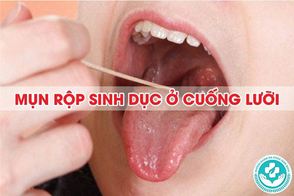 mụn rộp sinh dục ở cuống lưỡi