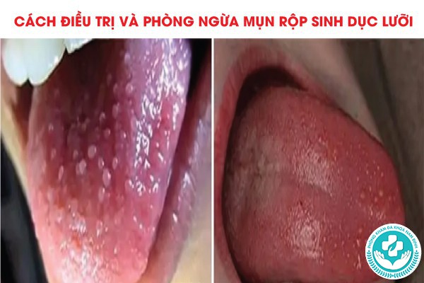 mụn rộp sinh dục ở cuống lưỡi