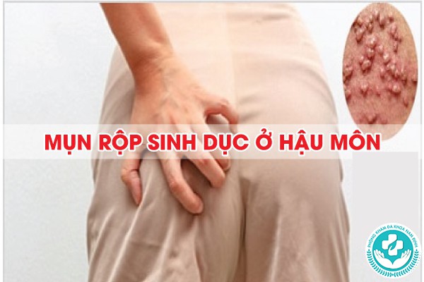 mụn rộp sinh dục ở hậu môn