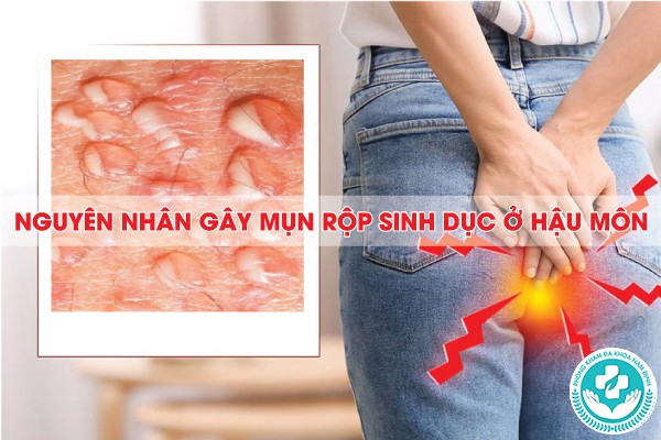 mụn rộp sinh dục ở hậu môn