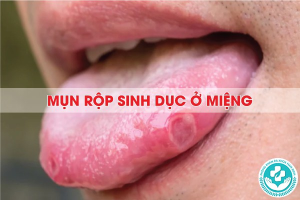 mụn rộp sinh dục ở miệng