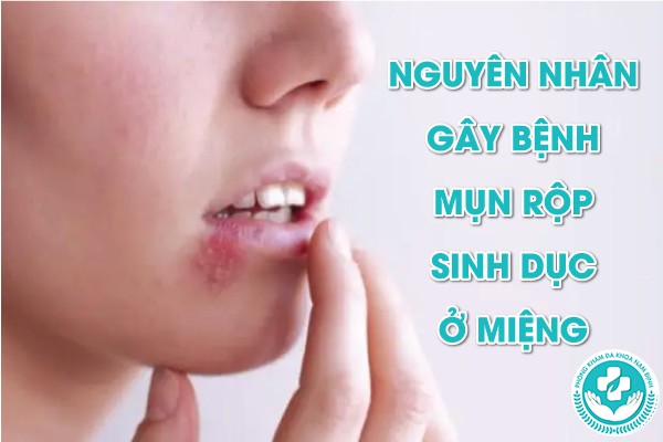 mụn rộp sinh dục ở miệng