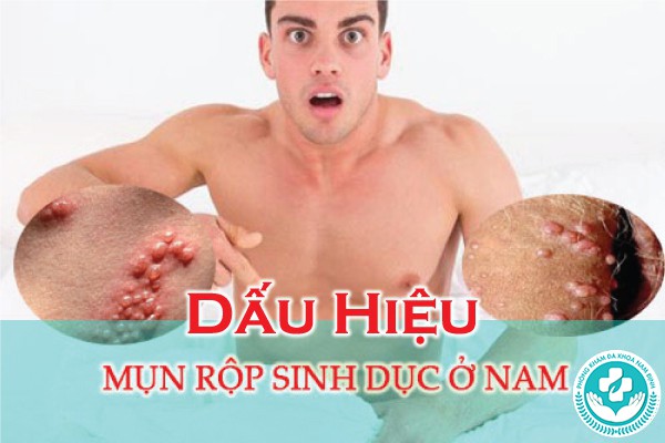 mụn rộp sinh dục ở nam giới