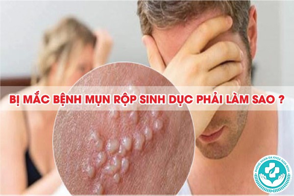 mụn rộp sinh dục ở nam giới