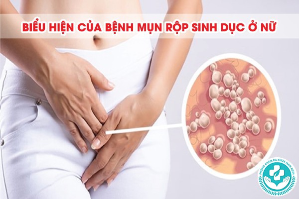 mụn rộp sinh dục ở nữ