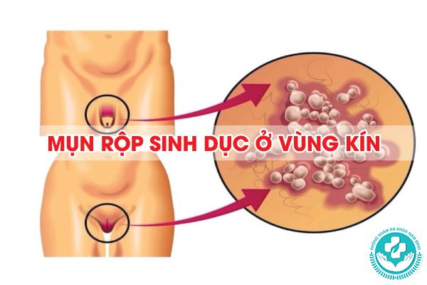 mụn rộp sinh dục ở vùng kín