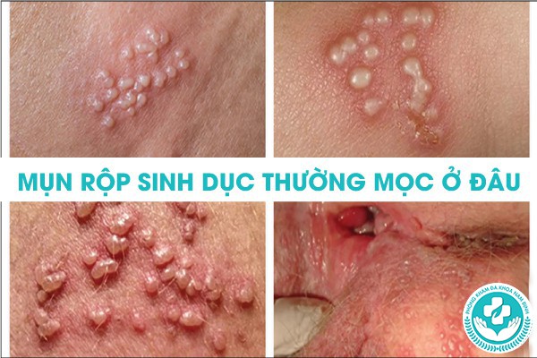 mụn rộp sinh dục thường mọc ở đâu