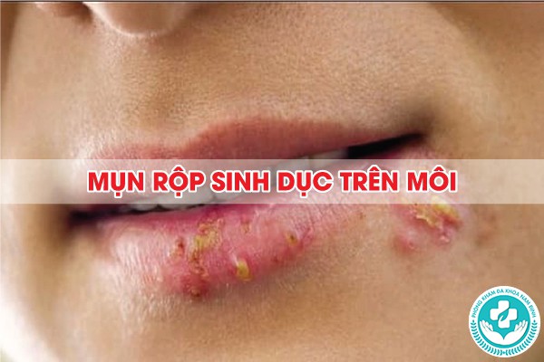 mụn rộp sinh dục thường mọc ở đâu