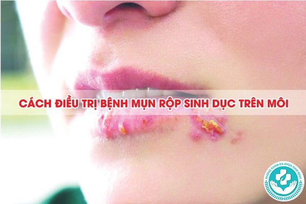 mụn rộp sinh dục trên môi