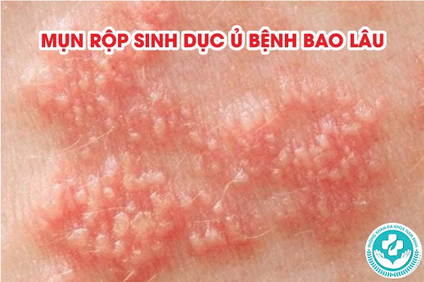 mụn rộp sinh dục ủ bệnh bao lâu