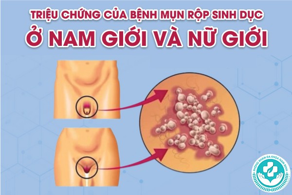 mụn rộp sinh dục ủ bệnh bao lâu