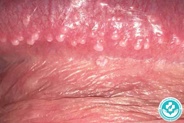mụn sinh dục lành tính