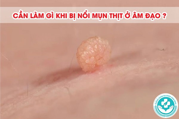 mụn thịt ở âm đạo