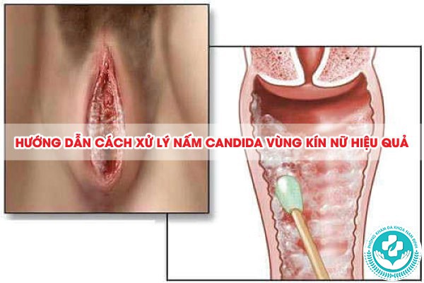 nấm candida ở vùng kín nữ