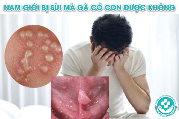 nam giới bị sùi mào gà có con được không