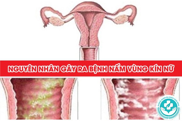 nấm vùng kín nữ