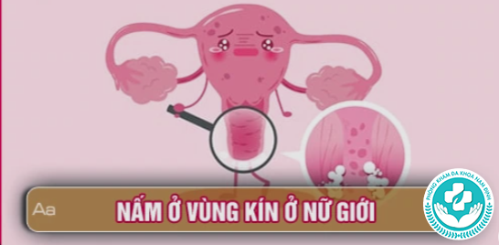Nấm vùng kín nữ có tự khỏi không