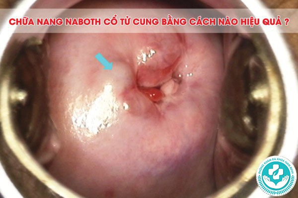 nang naboth cổ tử cung nang naboth cổ tử cung