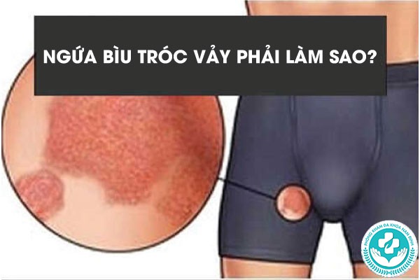 Ngứa bìu tróc vảy Ngứa bìu tróc vảy
