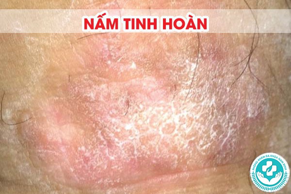 Ngứa bìu về đêm Ngứa bìu về đêm