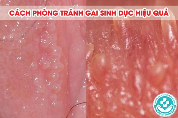nguyên nhân bị gai sinh dục