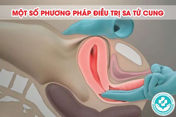 nguyên nhân bị sa tử cung